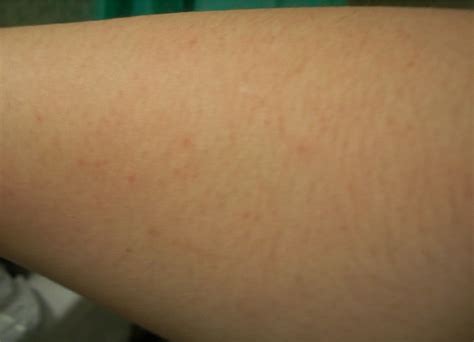 Itchy Red Spots On Skin In Pregnancy Red Bumps On The Side Of Your