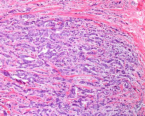 Human Breast Carcinoma Light Micrograph Stock Image C056 0849