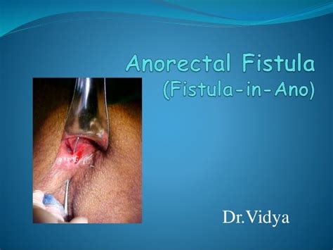 Ppt Anorectal Abscesses And Fistula In Ano Powerpoint Presentation Images