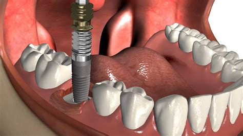 Implant Direct Los Implantes Dentales Youtube