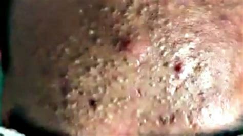 Acne Blackheads Whiteheads Removals On Face Part 9 Youtube