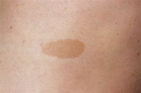 Cafe Au Lait Spots Causes Common Birthmarks Cancer Therapy Advisor