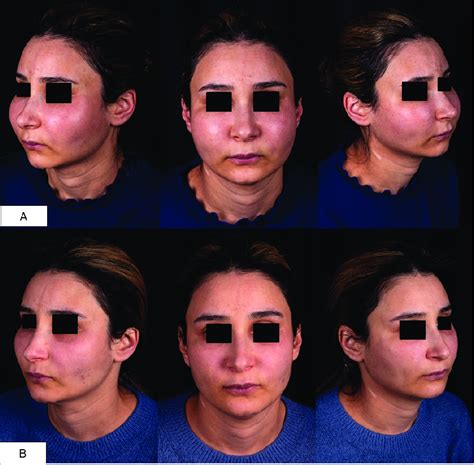 Clinical Presentation 17 Years After Dermal Filler Injection Into The