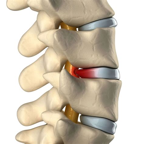 Bulging Disc Non Surgical Treatments Novus Spine And Pain Center