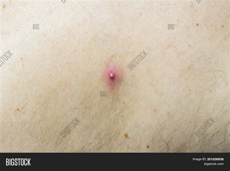 Pimple On Skin Light Image And Photo Free Trial Bigstock