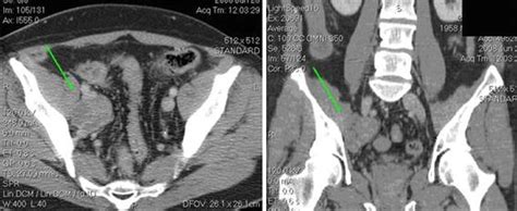 Contrast Enhanced Ct Of The Pelvis Showing Right Obturator Mass Arrow