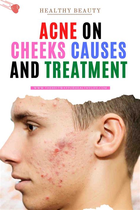 Acne On Cheek Causes