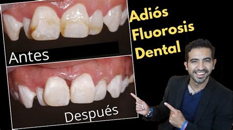 Que Es Fluorosis Dental Y Su Tratamiento Clinica Dental Trigemino