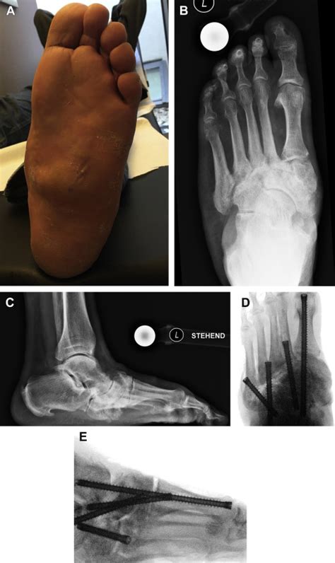 Surgical Treatment Options For The Diabetic Charcot Midfoot Deformity