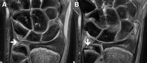 The triangular fibrocartilage complex (tfcc) is formed by the triangular fibrocartilage discus (tfc), the radioulnar ligaments (ruls) and the ulnocarpal ligaments (ucls). (A) MRI study showing a tear (arrow) in the ulnar portion ...