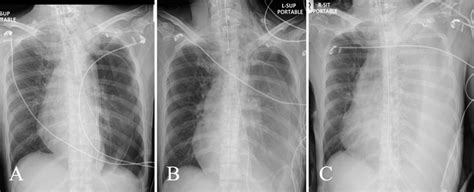 A C Serial Chest Radiographs Postoperative Days 1 2 And 6