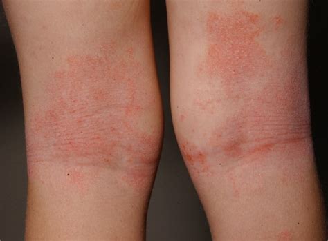 Atopic Dermatitis Eczema Concise Medical Knowledge