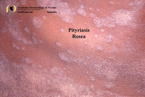 Pityriasis Rosea It Starts With A Herald Patch Academic