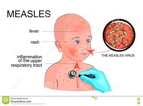 Measles Cartoons Illustrations And Vector Stock Images 69
