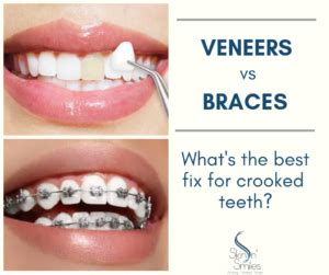It's difficult to fix crooked or gapped teeth without metal braces or invisible braces. Blog | Skin n' Smiles