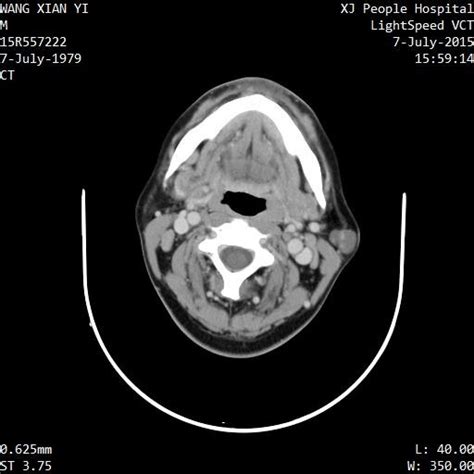 Parotid Malignant Tumor Figure 2 Parotid Pleomorphic Adenoma