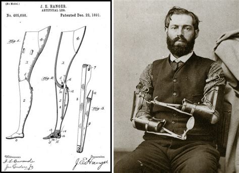 Redwoods Medical Edge The Civil War And Prosthetic Limbs 22