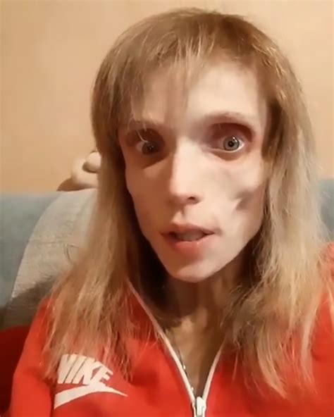 Anorexic Woman So Thin She Could Play A Living Corpse In Horror Movie