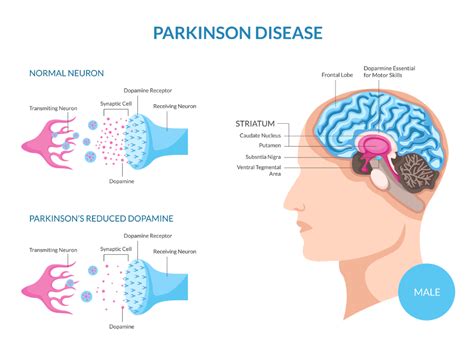 Parkinsons Nutritional Therapist Tavistock Devon And The South