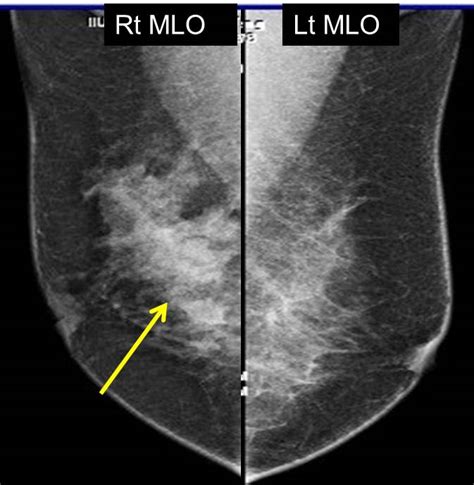 Benign Multiple Papillary Lesions Of The Breast Radiology Cases