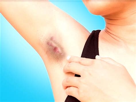 How To Get Rid Of Armpit Lumps By Simple Home Remedies Rs आर्मपिट में
