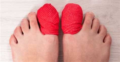 Why Do Runners Lose Toenails Plus 3 Preventative Actions Fitter Habits