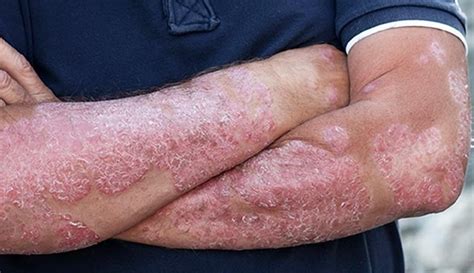 Psoriasis What It Is Symptoms Causes Types And Treatment