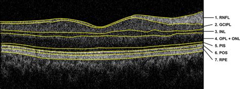 Oct Images Acquired Using Topcon 3d Oct 1000 The Seven Retinal Layers