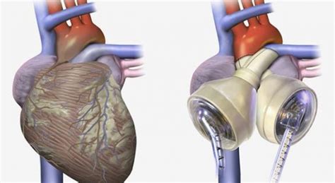 Realizan El Primer Implante De Un Corazón Artificial En España