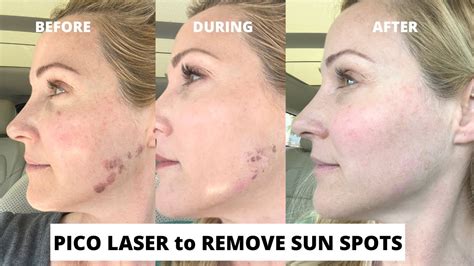 Pico Laser Treatment To Remove Sun Spots Before And After With Dr