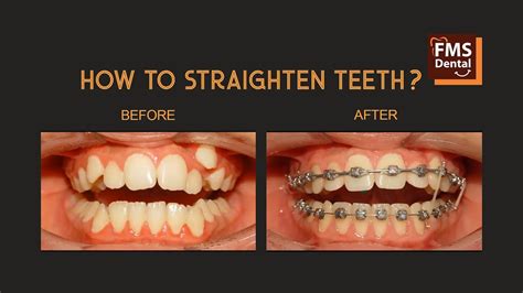 How To Straighten Teeth