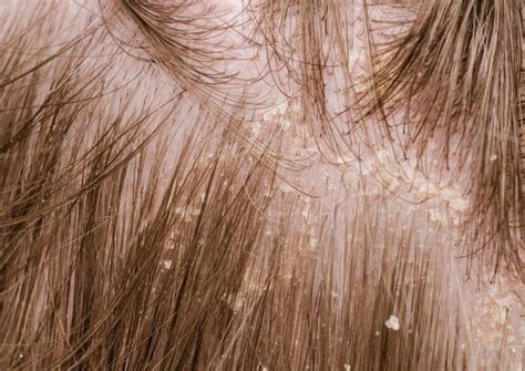 What Are The Different Types Of Dandruff With Pictures