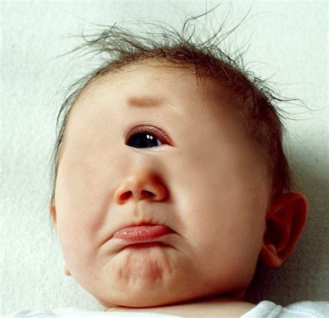 The One Eyed Syndrome Birth Defects A Child Is Born Birth