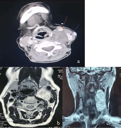 A An Axial Ct Of The Neck Revealing An Oval Heterogeneous Mass In The
