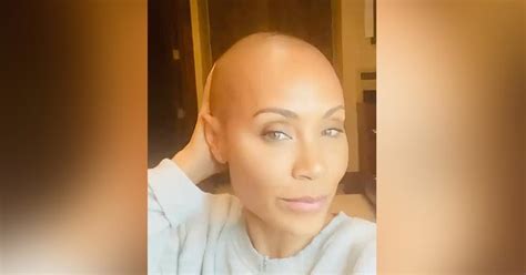 Jada Pinkett Smith Shares Struggle With Alopecia