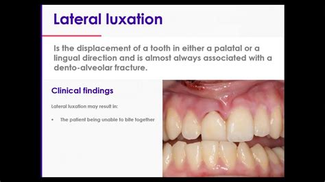 11 Traumatic Dental Injuries Part 2 Luxation Injuries Type 4