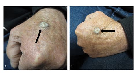 Cureus Cutaneous Squamous Cell Carcinoma Masquerading As A Verruca
