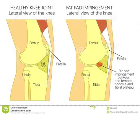 Anatomia Knee Fat Ochraniacza Impingement Syndrom Ilustracja Wektor