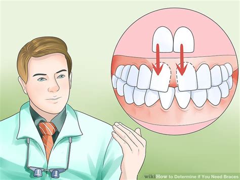 You may be wondering how to know if you need braces, so we've put together a list. How to Determine if You Need Braces (with Pictures) - wikiHow