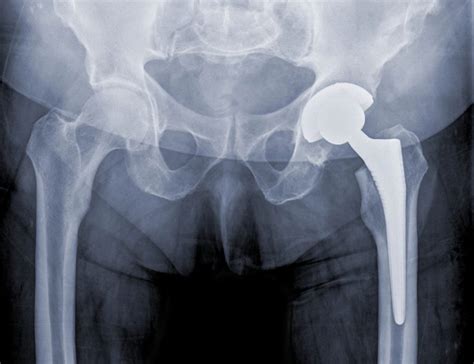 Stryker Hip Replacement Metal Blood Poisoning Lawsuit Filed Over