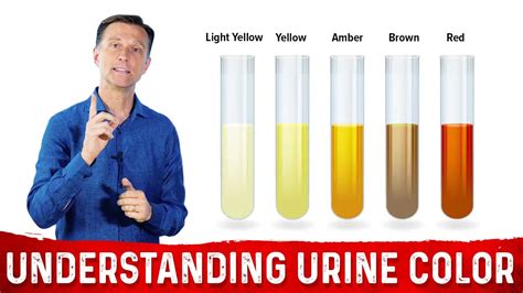 Dark Amber Urine Color Means