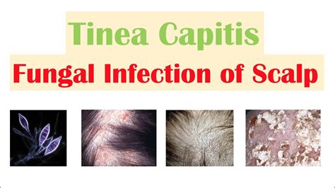 Fungal Infection Of The Scalp Tinea Capitis Causes Risk Factors