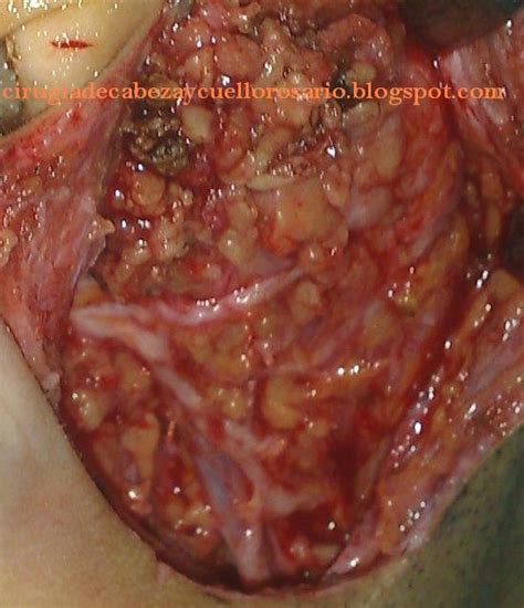 Adenoma pleomorfo mi permetto di segnalare questa pagina che forse spiega il problema: Cirugía de Cabeza y Cuello Rosario: TUMOR DE PAROTIDA