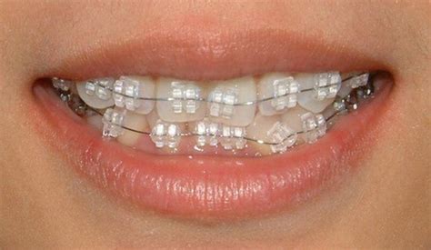 Clear Braces With Coloured Bands Exorbitant Blook Pictures Library