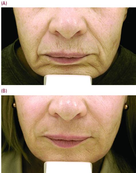 Laser Resurfacing Can Effectively Minimize Post Surgery Scars Mdedge