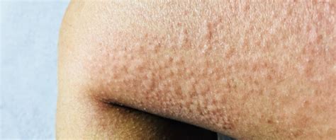 أسباب حساسية الجلد المفاجئة وعلاجها ايميجز