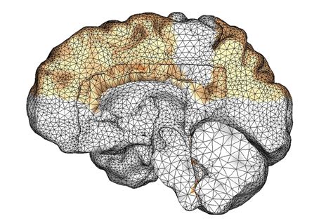 Alzheimer's disease (ad) is a neurodegenerative disease that usually starts slowly and progressively worsens. How Alzheimer's disease spreads through the brain - Tech ...