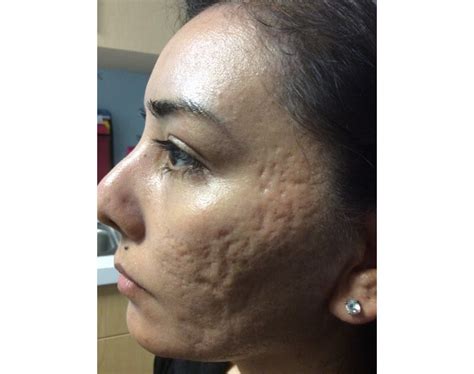 Women With Acne Scars