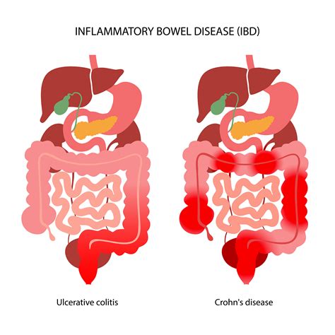 Inflammatory Bowel Disease Uf Health