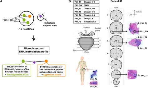 Prostate cancer is also given a grade called a gleason score. Identifying aggressive prostate cancer foci using a DNA ...